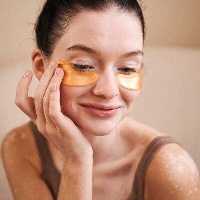 Early Signs of Vitiligo